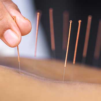 Acupuncture body close up