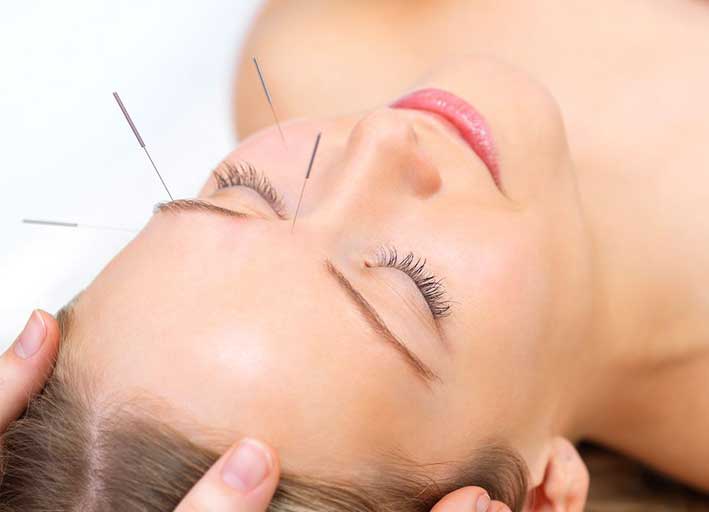 BENEFITS OF FACIAL ACUPUNCTURE