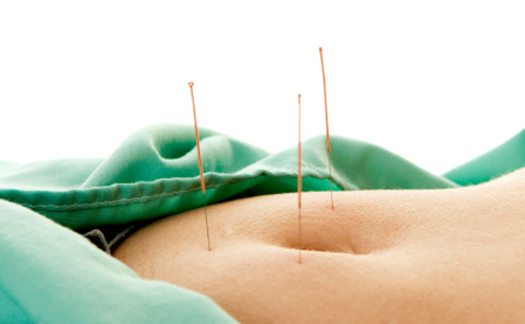 acupuncture for Endometriosis